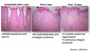 Skin-Regeneration-Process-After-Fractional-CO2-Laser-e1408129601634-300x170.jpg