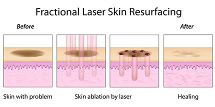 skin-laser.jpg